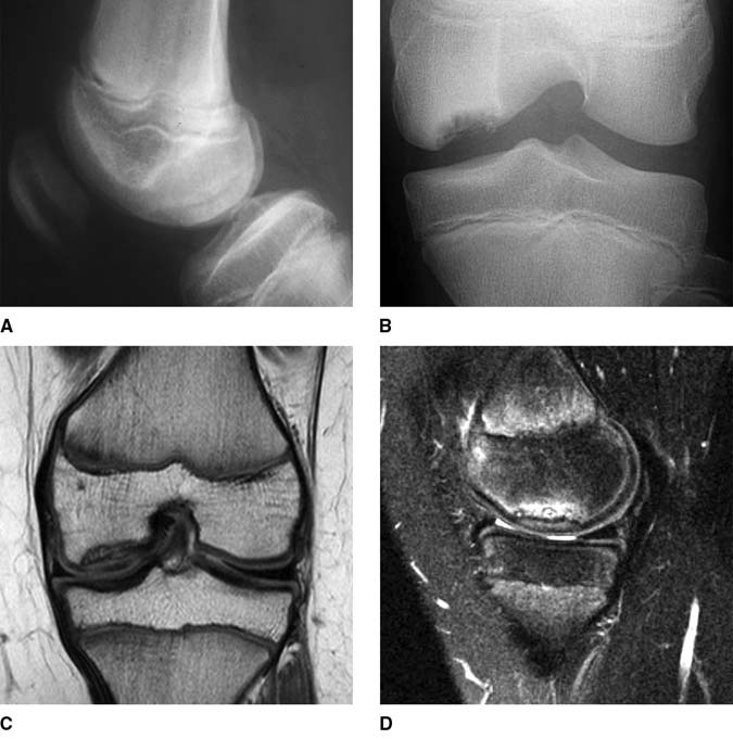 Osteochondritis Dissecans Knee